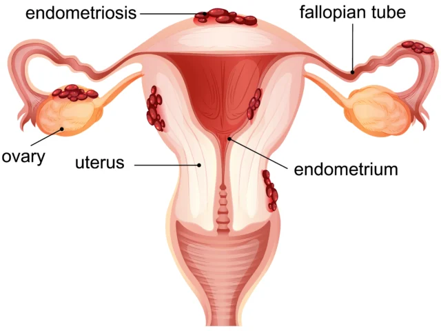 What is Endometriosis? Symptoms, Causes & Treatment