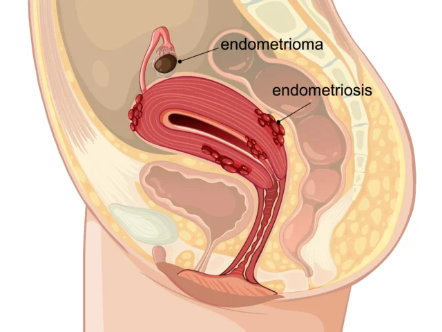Laparoscopy vs Open Surgery for Endometriosis: Which Is Right for You?
