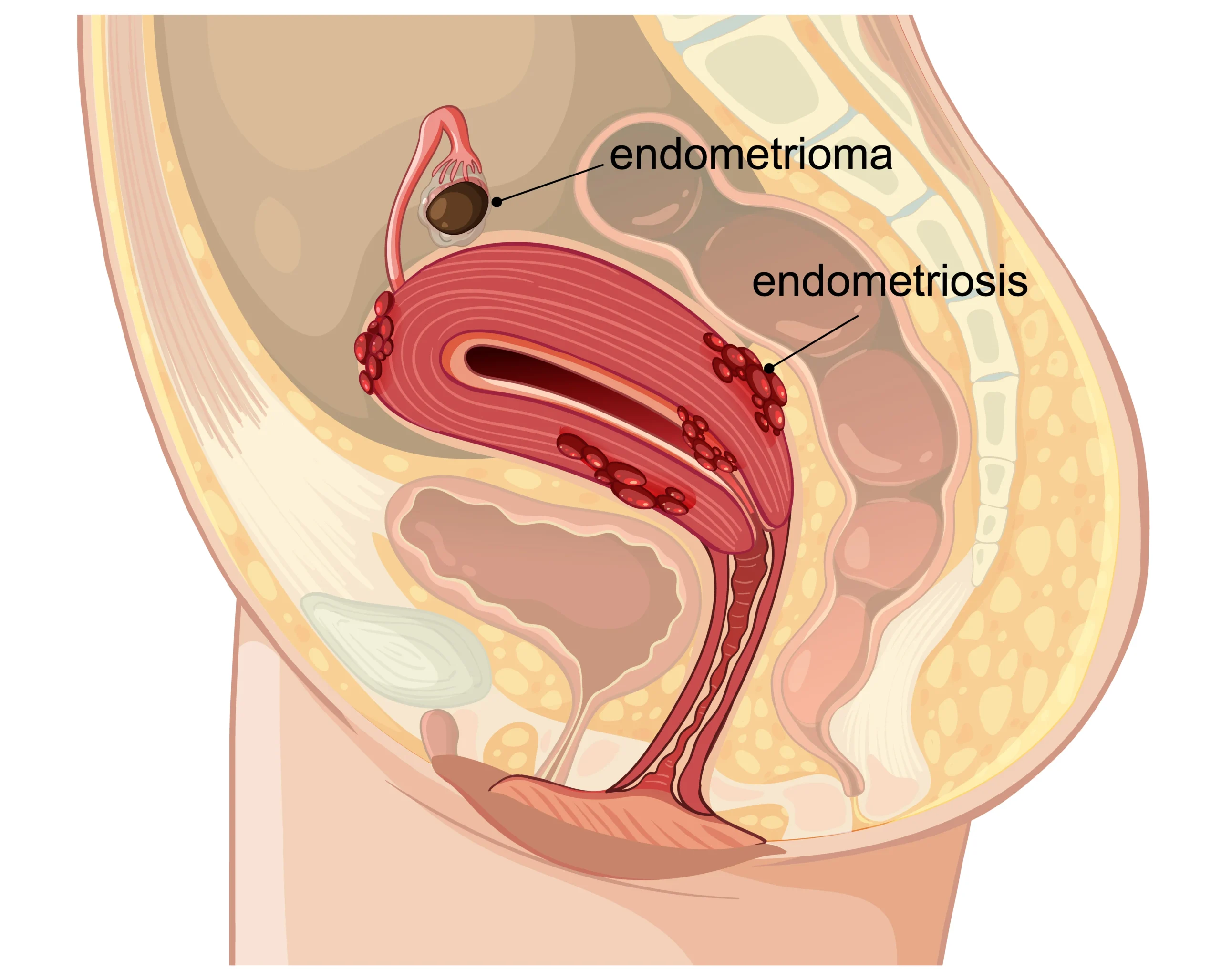 Laparoscopy vs Open Surgery for Endometriosis: Which Is Right for You?
